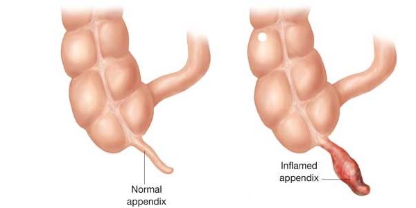 Symptoms Of Appendicitis