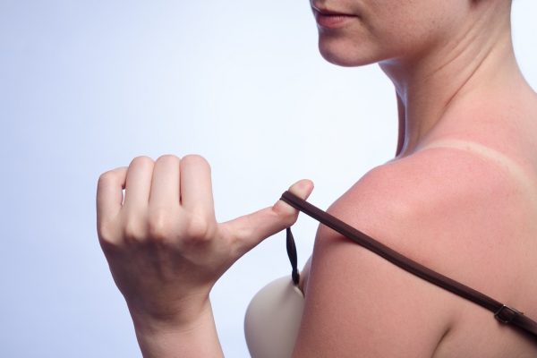 10 Foods That Can Help Prevent Sunburn Of The Skin